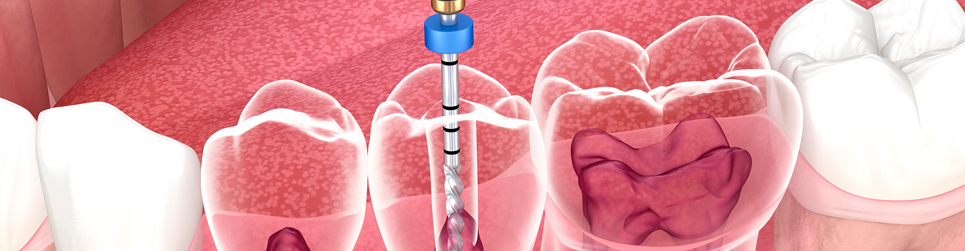 rendering of a root canal tool in a transparent tooth